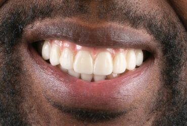 Professional Teeth Whitening for a Brighter Katy Smile