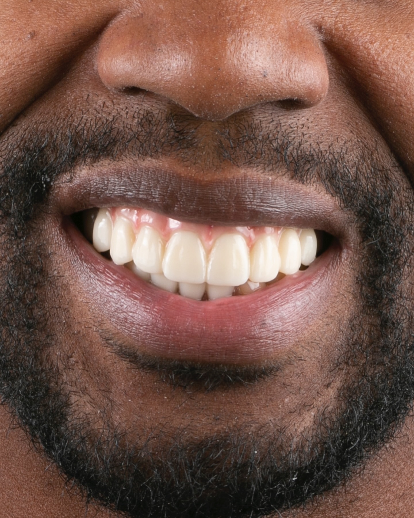 Professional Teeth Whitening for a Brighter Katy Smile