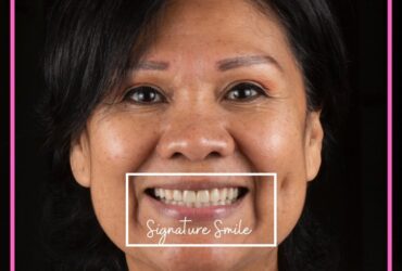 Full Mouth Dental Implants in Katy, TX | Permanent Restoration