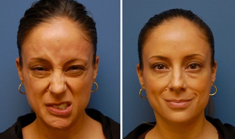 The Facial Paralysis Institute