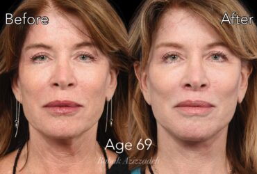 Center For Advanced Facial Plastic Surgery